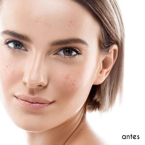 Corrector de imperfecciones - Zit Zapper 2.3g correctores de maquillaje Couleur Caramel 